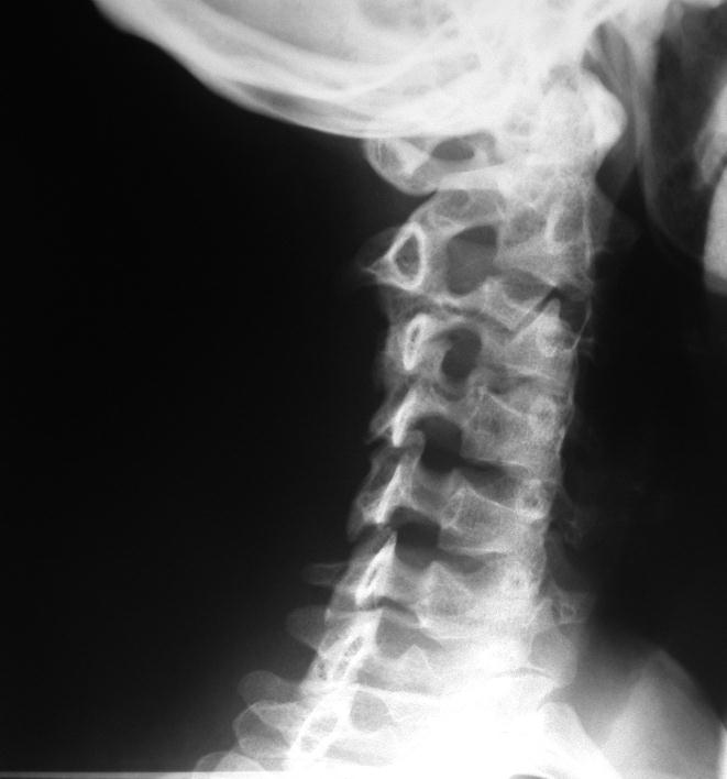 Coluna Cervical: