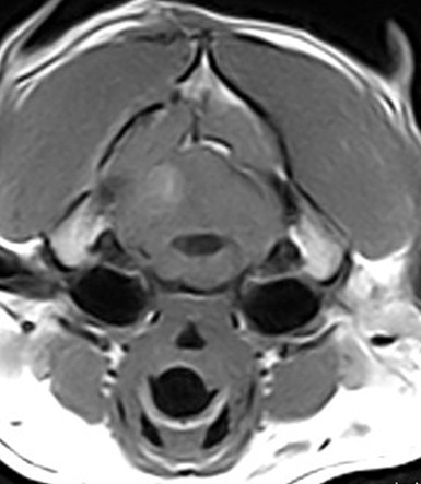 CASOS CLÍNICOS Estas informações imagiológicas eram fortemente sugestivas de meningioma.