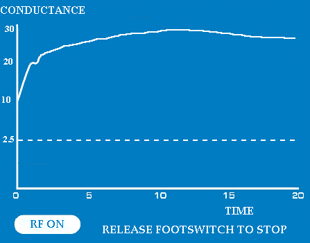 Figura 9 Mostrador gráfico de energia indicando o modo RF LIGADA Os gráficos de condutância e energia estão em uma escala de 20 segundos.