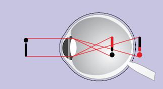 Os astigmatismos médios e altos alteram a visão igualmente para perto e para longe e podem ser responsáveis pelas queixas de desconforto e fadiga ocular, dor de cabeça, dentre outros (BRASIL, 2008, p.