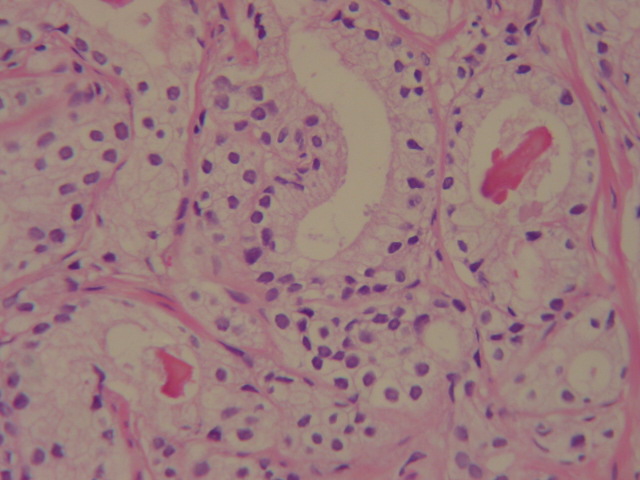 18 FIGURA 2 - ASPECTO HISTOLÓGICO DE NEOPLASIA DE GRAU 2 PELA DEFINIÇÃO DE GLEASON Caso número 09 (H&E, 400X) O grau 3 contém três padrões distintos.