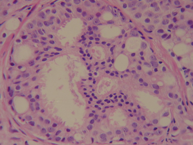 19 FIGURA 3 - ASPECTO HISTOLÓGICO DE NEOPLASIA DE GRAU 3 PELA DEFINIÇÃO DE GLEASON Caso número 31 (H&E, 400X) O grau 4 contém dois padrões.