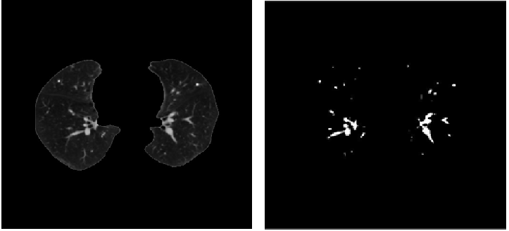 (a) Parênquima Pulmonar (b) Canditados a nódulos pulmonares Figura 5. Resultado da segmentação dos candidatos a nódulos pulmonares. 4.