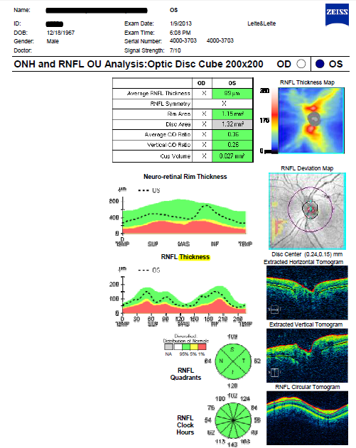 Figura 9- OCT OE avaliação zona macular Figura 10 - OCT OE avaliação zona macular com mapeamento de espessuras da mácula Como é possivel verificar na figura 9,acima representada, as camadas da retina