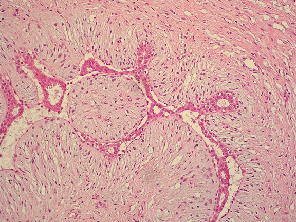 assintomática Citologia aspirativa Microbió Microbiópsia Mastectomia se Carcinoma Diag.