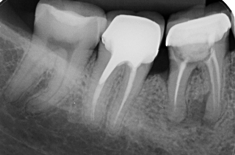 A imagem de diminuição do espaço periodontal é vista como linha radiolúcida delgada em uma região ou em torno de todo o dente.