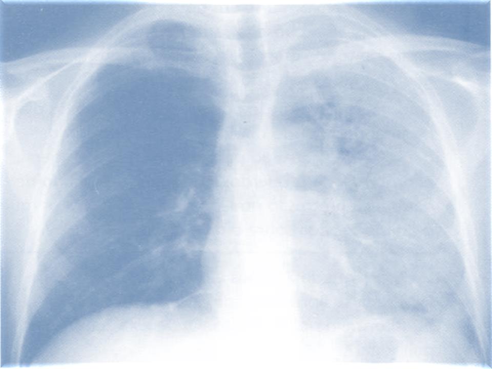 Smithard et al descreveram a redução da incidência de pneumonia aspirativa de 51% no primeiro dia para