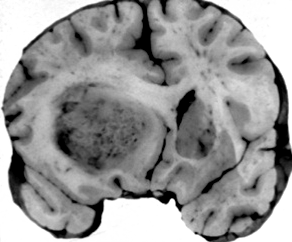 glioblastoma