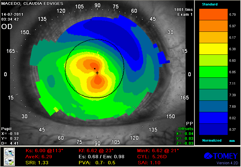 Figura 2. Topografia Corneal do OD Figura 3.