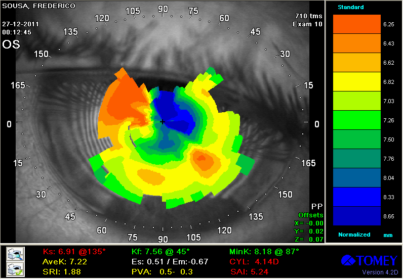 realizar Subjectivo -3,00-2,75*105 (AV= 0,6) --------- (AV= 0,01) (AV=0,6) Biomicroscopia Nervos corneais Estrias de Vogt Adelgaçamento