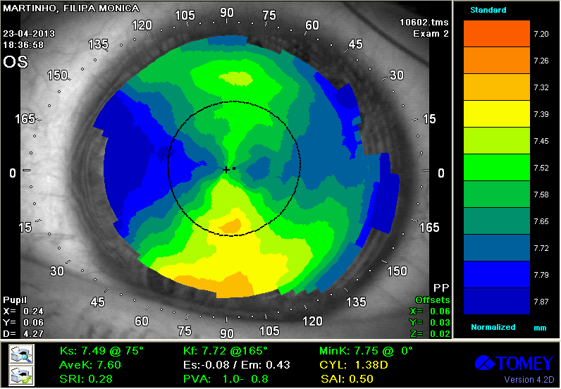 Figura 11. Topografia Corneal do OE Diagnóstico e Discussão: Segundo análise da topografia foi diagnosticada uma ectasia Corneal após cirurgia refrativa.