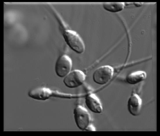 Materiais e Método MSOME Incidência de espermatozoides contendo vacúolos grandes (>13 % da área nuclear)