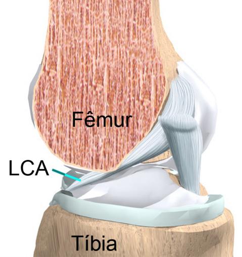 Lesão do LCA Introdução O ligamento cruzado anterior (LCA) é provavelmente o ligamento mais lesado do joelho. Na maioria dos casos, a lesão ocorre em pessoas que participam de atividades físicas.