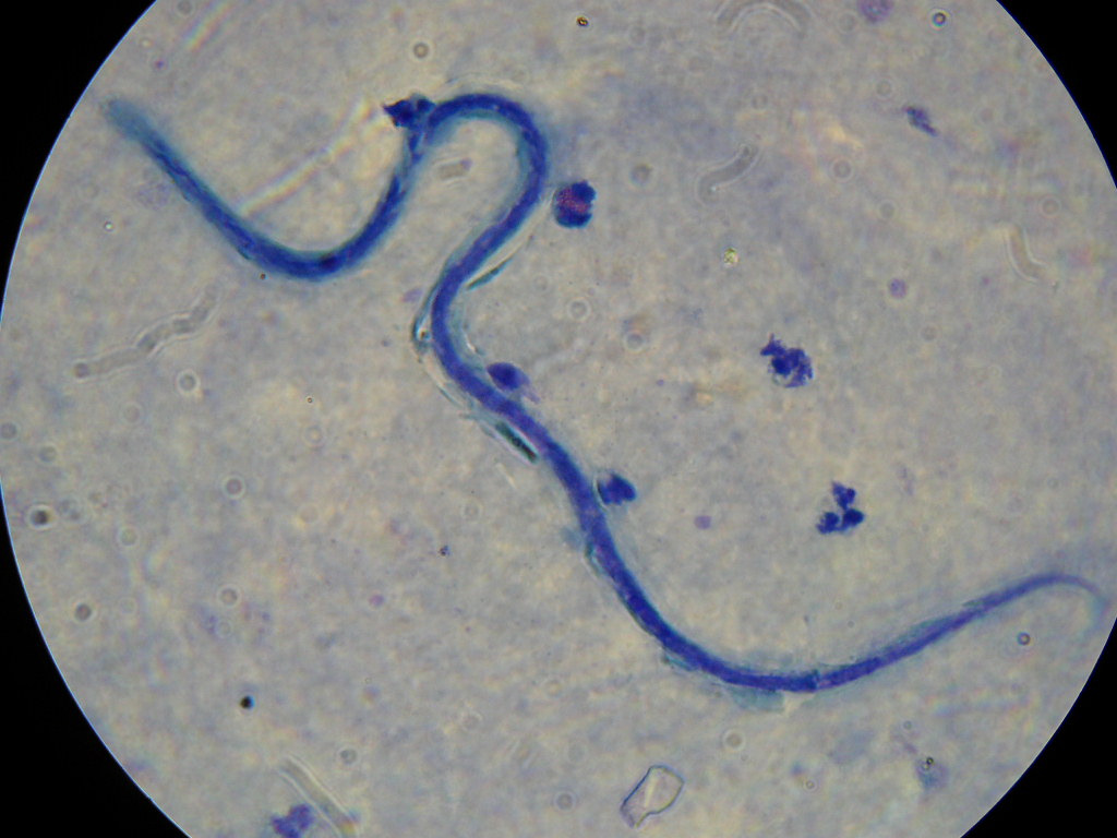 Onchocerca volvulus verme adulto e microfilária verme adulto http://www.icp.ucl.ac.be/~opperd/parasites/onch1.