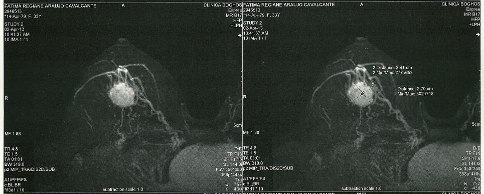10/04/13 Ressonância Magnética das Mamas (02/04/13): Nódulo 2.