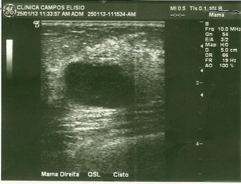 Exame que trazia consigo: USG Mamas (25/01/2013): BI-RADS: 2 Imagem cística com finos debris
