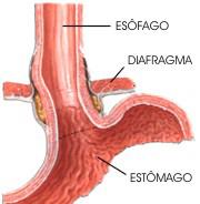 REFLUXO GASTROESOFÁGICO Doença que frequentemente