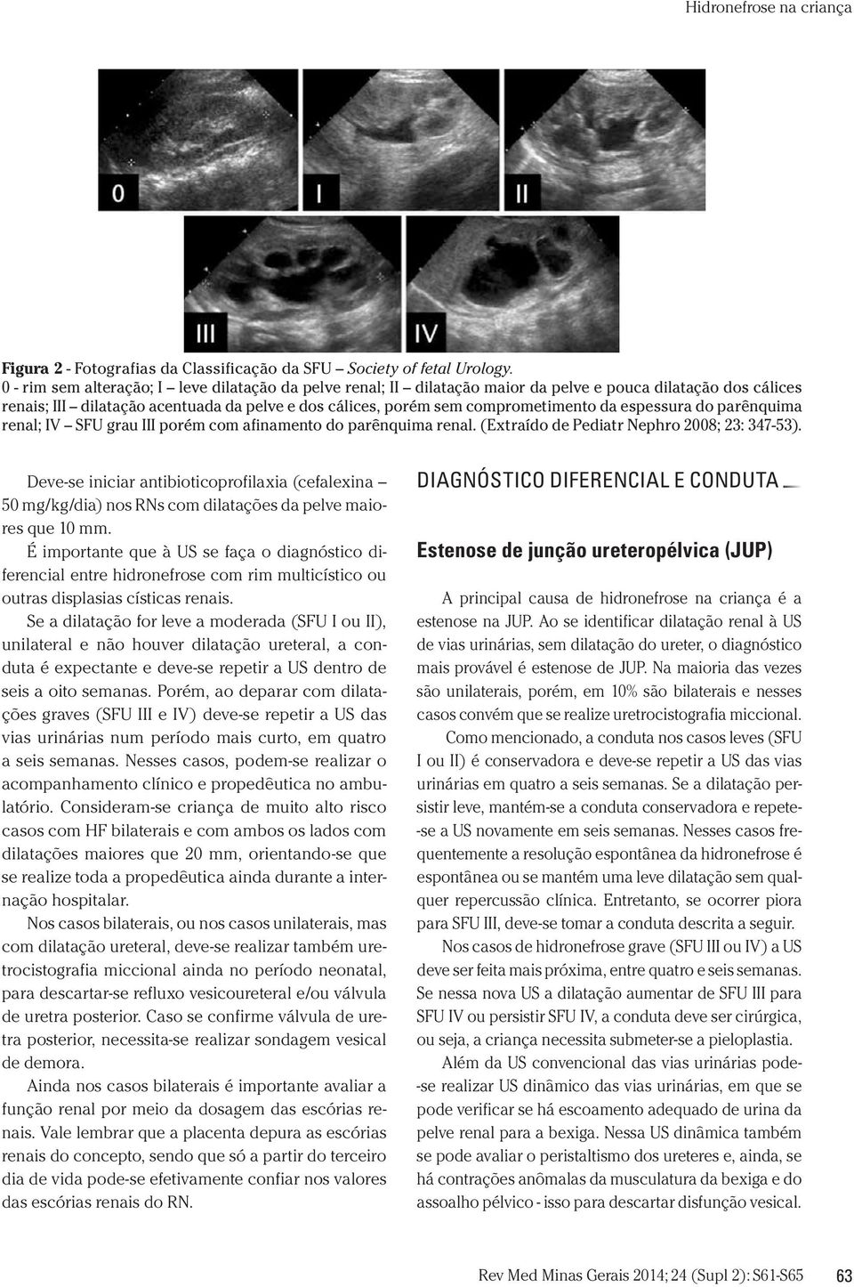 espessura do parênquima renal; IV SFU grau III porém com afinamento do parênquima renal. (Extraído de Pediatr Nephro 2008; 23: 347-53).