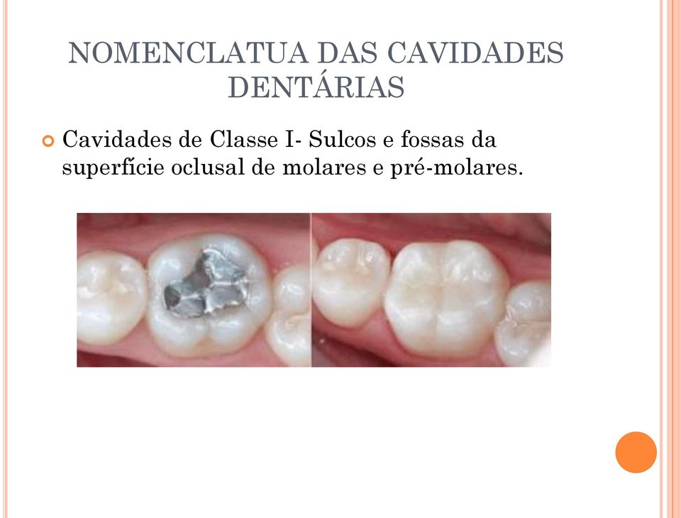 I- Sulcos e fossas da