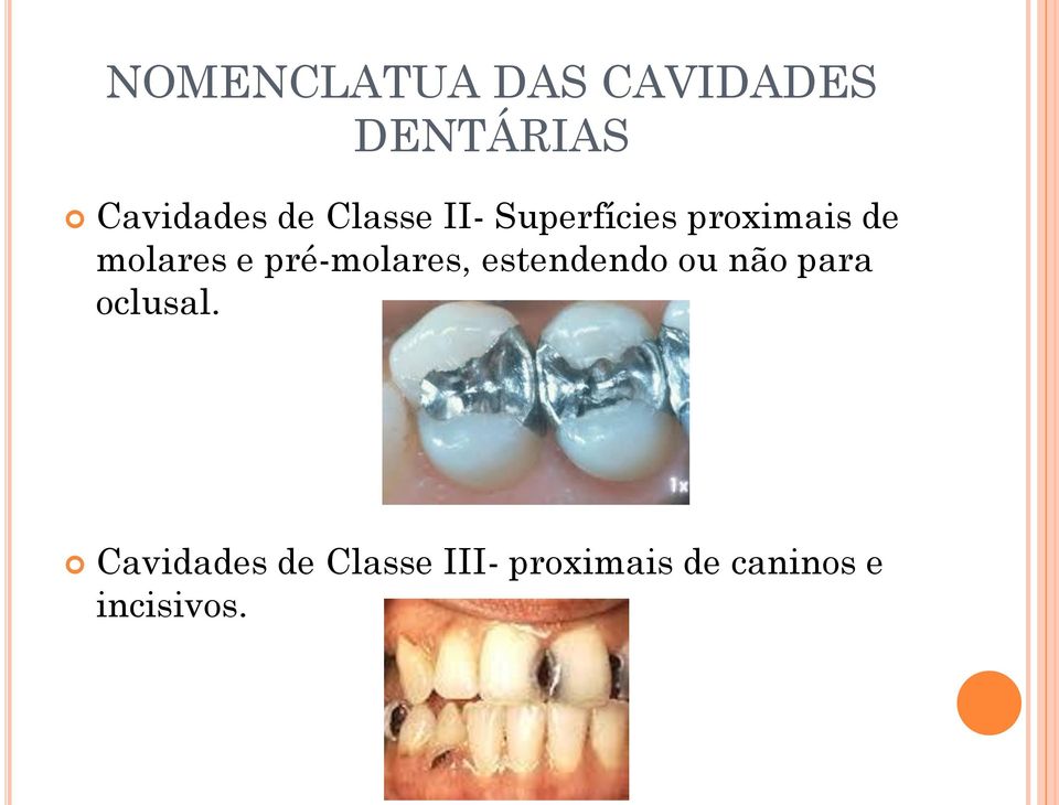 pré-molares, estendendo ou não para oclusal.