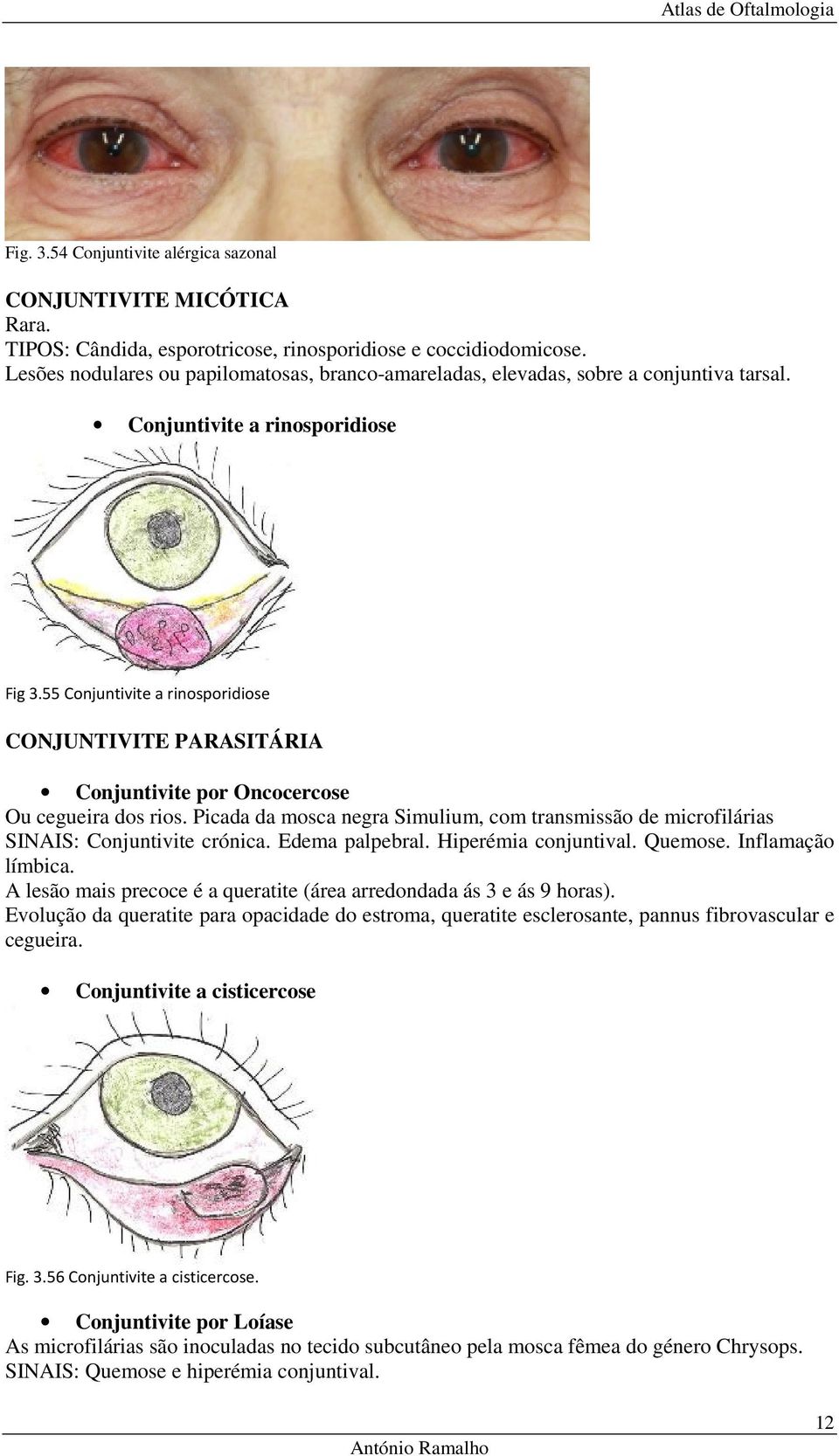 55 Conjuntivite a rinosporidiose CONJUNTIVITE PARASITÁRIA Conjuntivite por Oncocercose Ou cegueira dos rios.