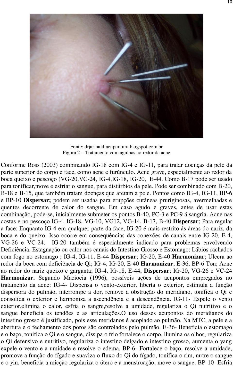 Acne grave, especialmente ao redor da boca queixo e pescoço (VG-20,VC-24, IG-4,IG-18, IG-20, E-44. Como B-17 pode ser usado para tonificar,move e esfriar o sangue, para distúrbios da pele.