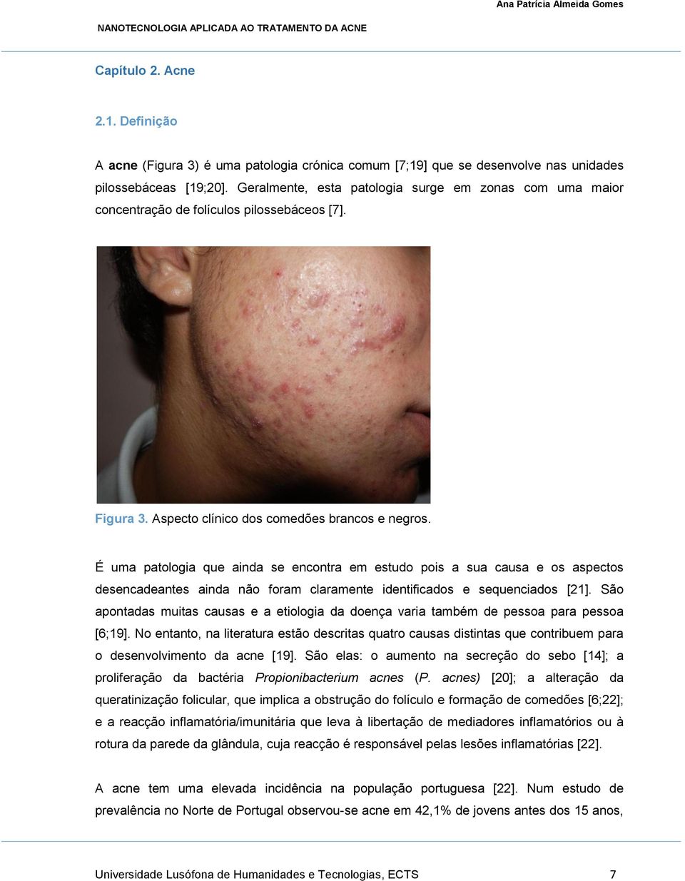 É uma patologia que ainda se encontra em estudo pois a sua causa e os aspectos desencadeantes ainda não foram claramente identificados e sequenciados [21].