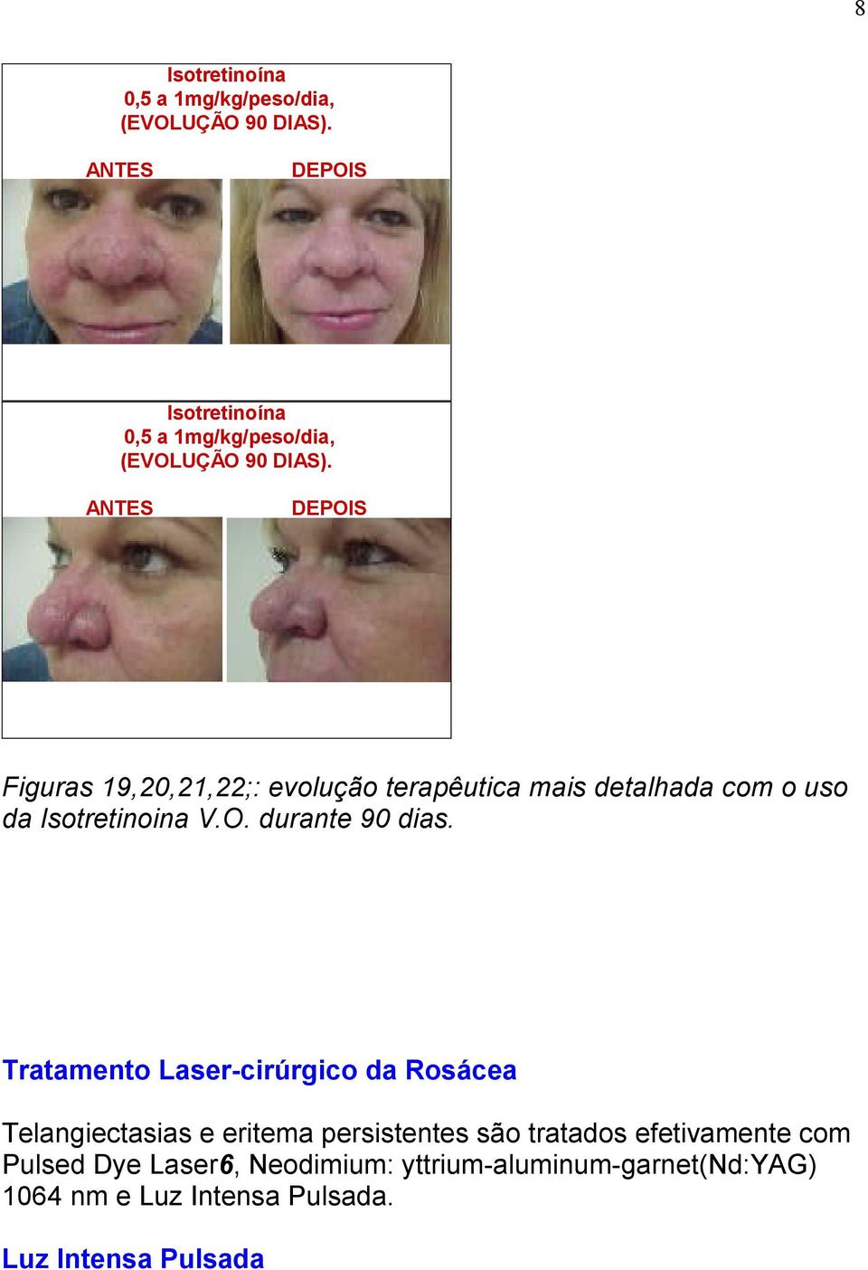 ANTES DEPOIS Figuras 19,20,21,22;: evolução terapêutica mais detalhada com o uso da Isotretinoina V.O. durante 90 dias.