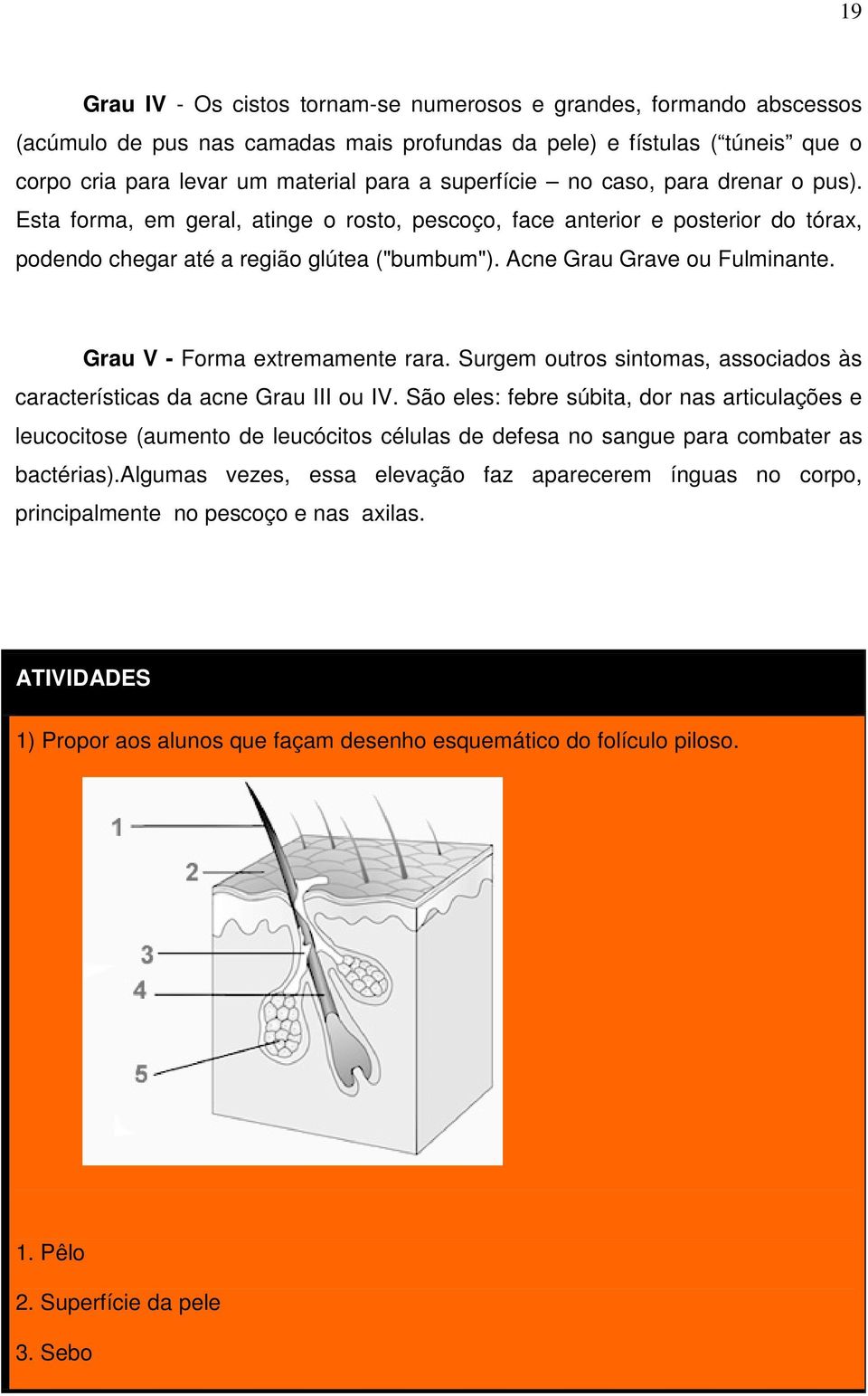 Grau V - Forma extremamente rara. Surgem outros sintomas, associados às características da acne Grau III ou IV.