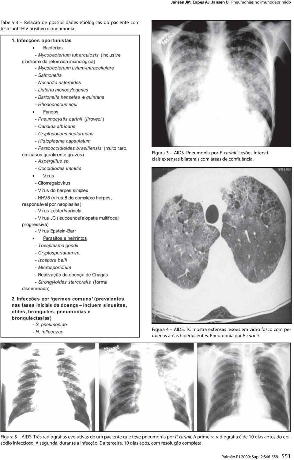 TC mostra extensas lesões em vidro fosco com pequenas áreas hiperlucentes. Pneumonia por P. carinii. Figura 5 AIDS.