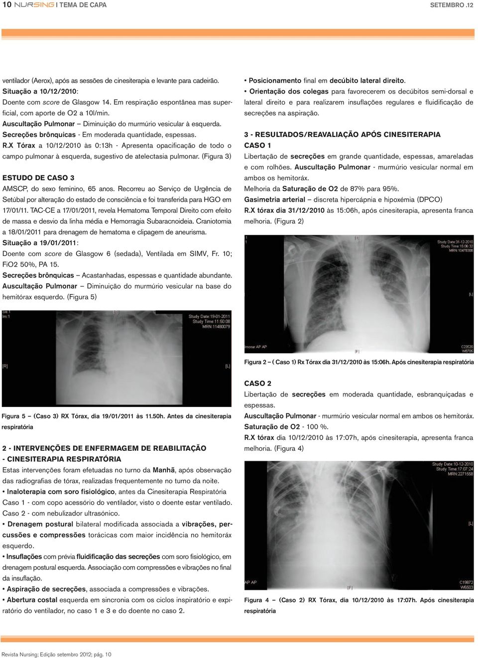 X Tórax a 10/12/2010 às 0:13h - Apresenta opacificação de todo o campo pulmonar à esquerda, sugestivo de atelectasia pulmonar. (Figura 3) ESTUDO DE CASO 3 AMSCP, do sexo feminino, 65 anos.