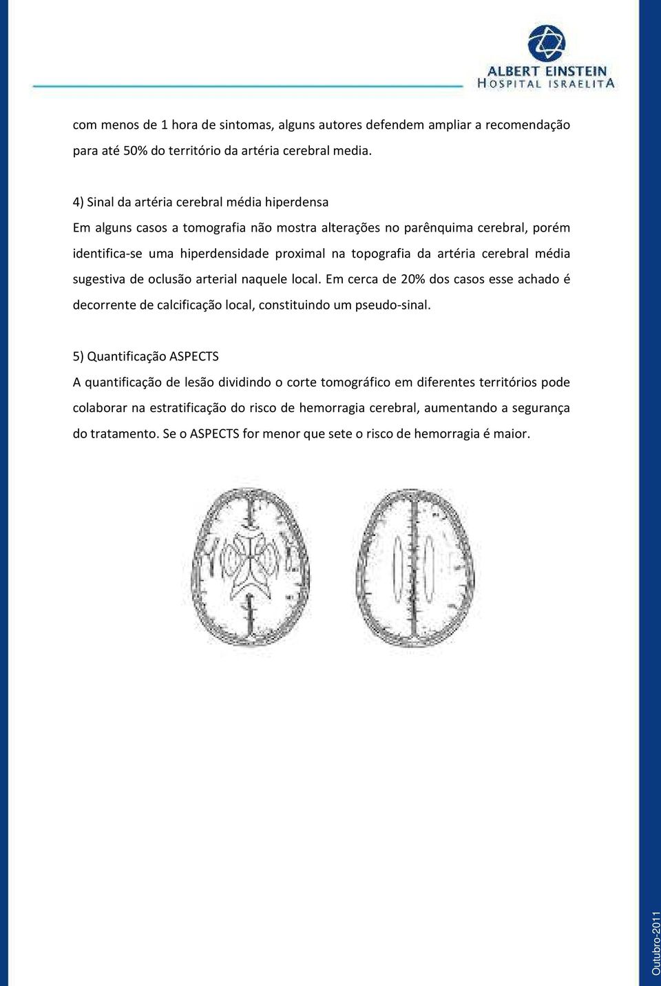 artéria cerebral média sugestiva de oclusão arterial naquele local. Em cerca de 20% dos casos esse achado é decorrente de calcificação local, constituindo um pseudo-sinal.