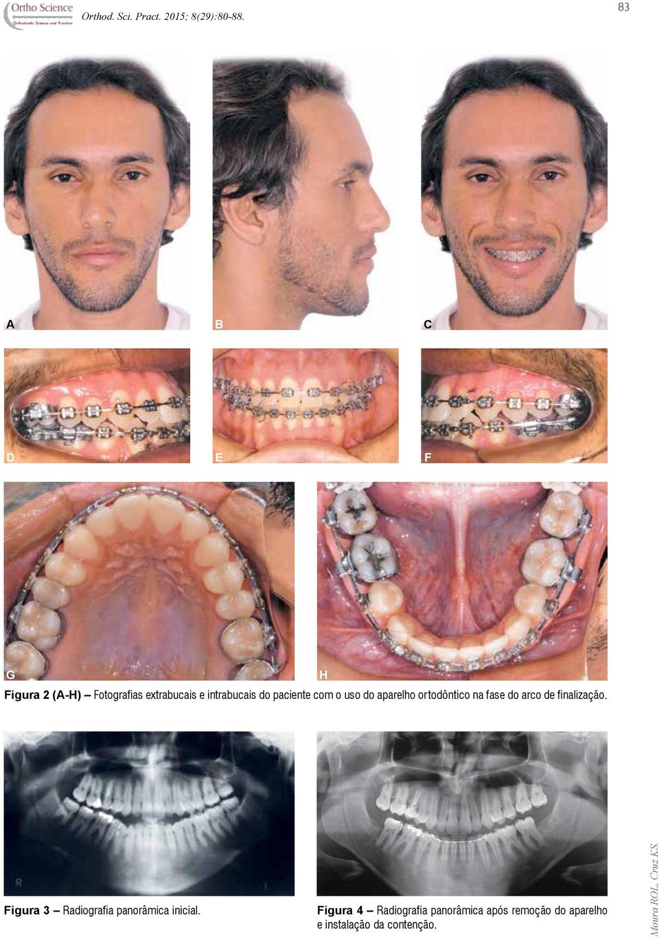 finalização. Figura 3 Radiografia panorâmica inicial.