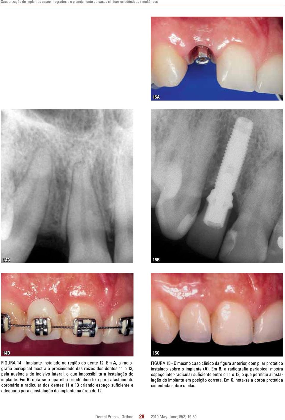 Em B, nota-se o aparelho ortodôntico fixo para afastamento coronário e radicular dos dentes 11 e 13 criando espaço suficiente e adequado para a instalação do na área do 12.