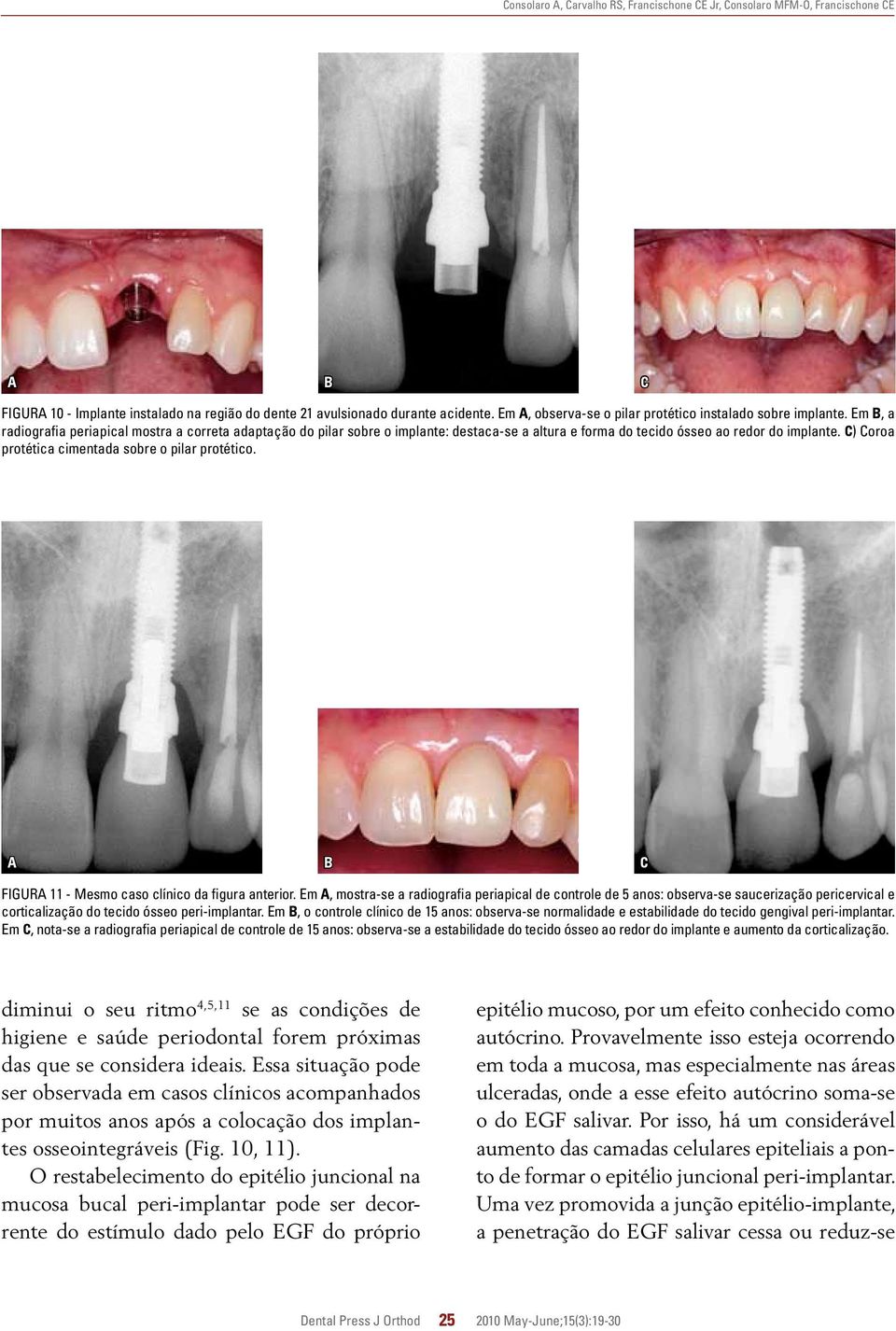 C) Coroa protética cimentada sobre o pilar protético. A B C FIGURA 11 - Mesmo caso clínico da figura anterior.