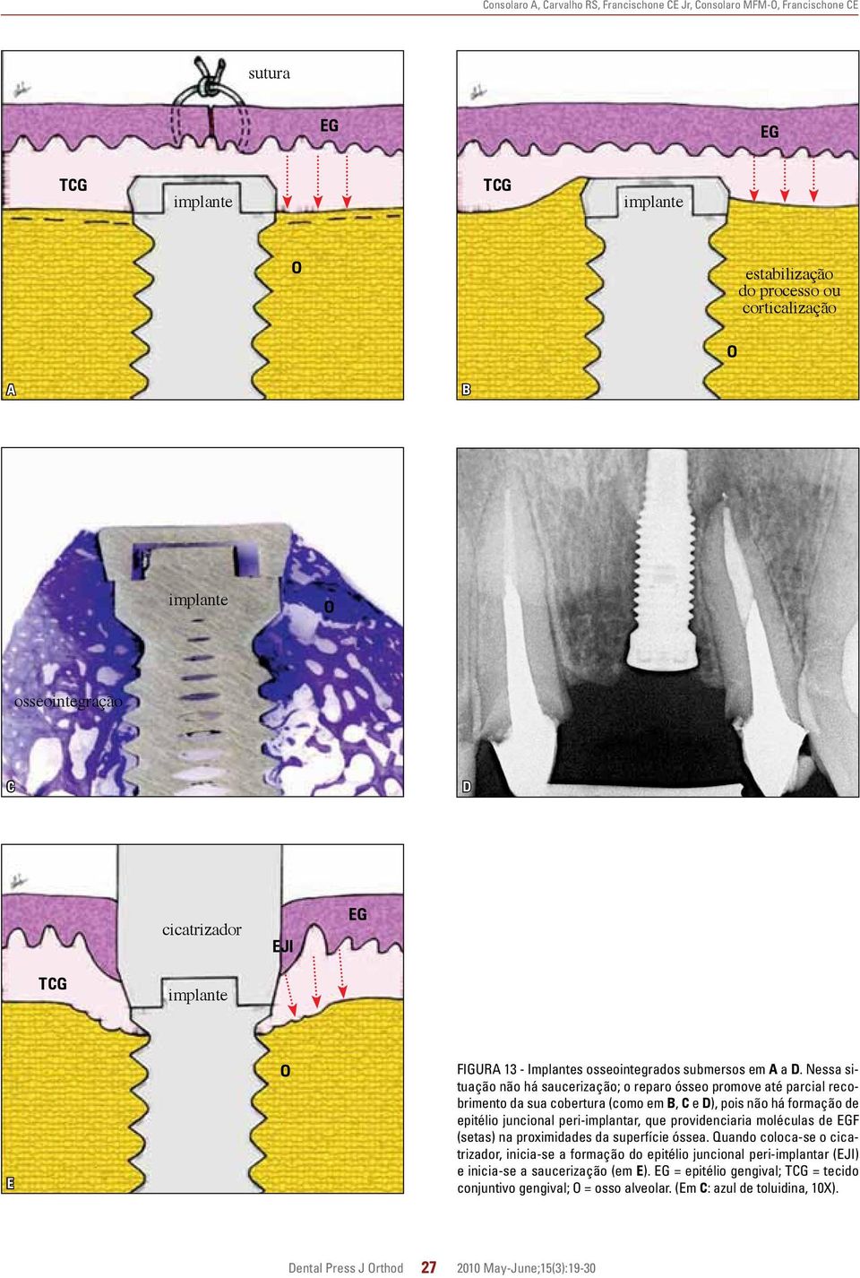 Nessa situação não há saucerização; o reparo ósseo promove até parcial recobrimento da sua cobertura (como em B, C e D), pois não há formação de epitélio juncional peri-implantar, que