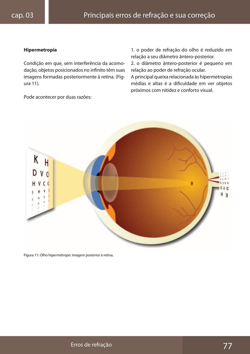 o poder de refração do olho é reduzido em relação a seu diâmetro ântero-posterior. 2.