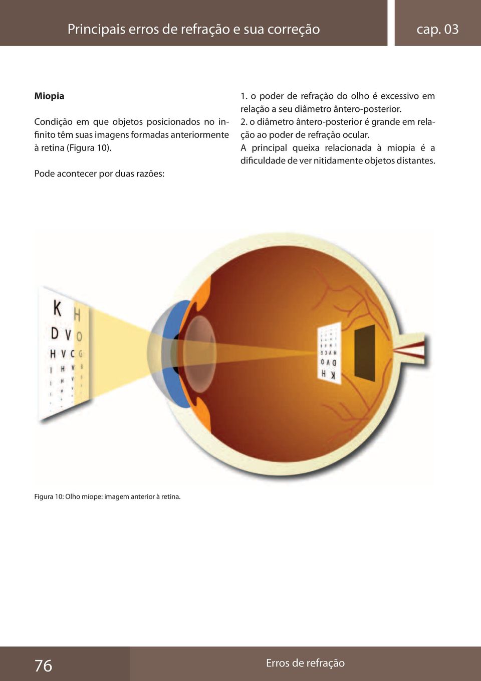Pode acontecer por duas razões: 1. o poder de refração do olho é excessivo em relação a seu diâmetro ântero-posterior. 2.