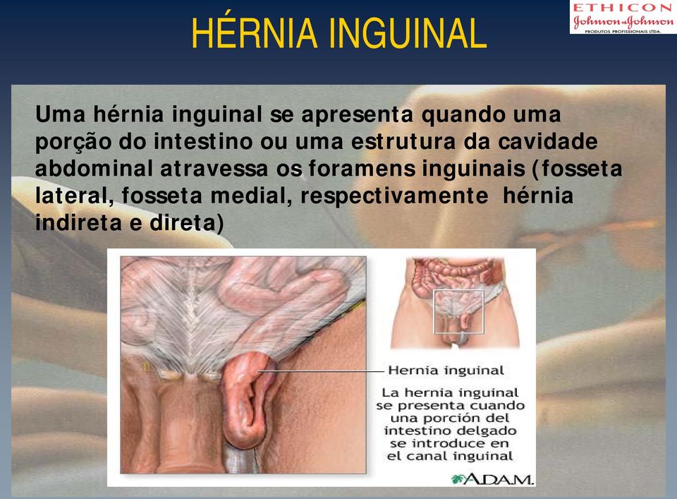 abdominal atravessa os foramens inguinais (fosseta