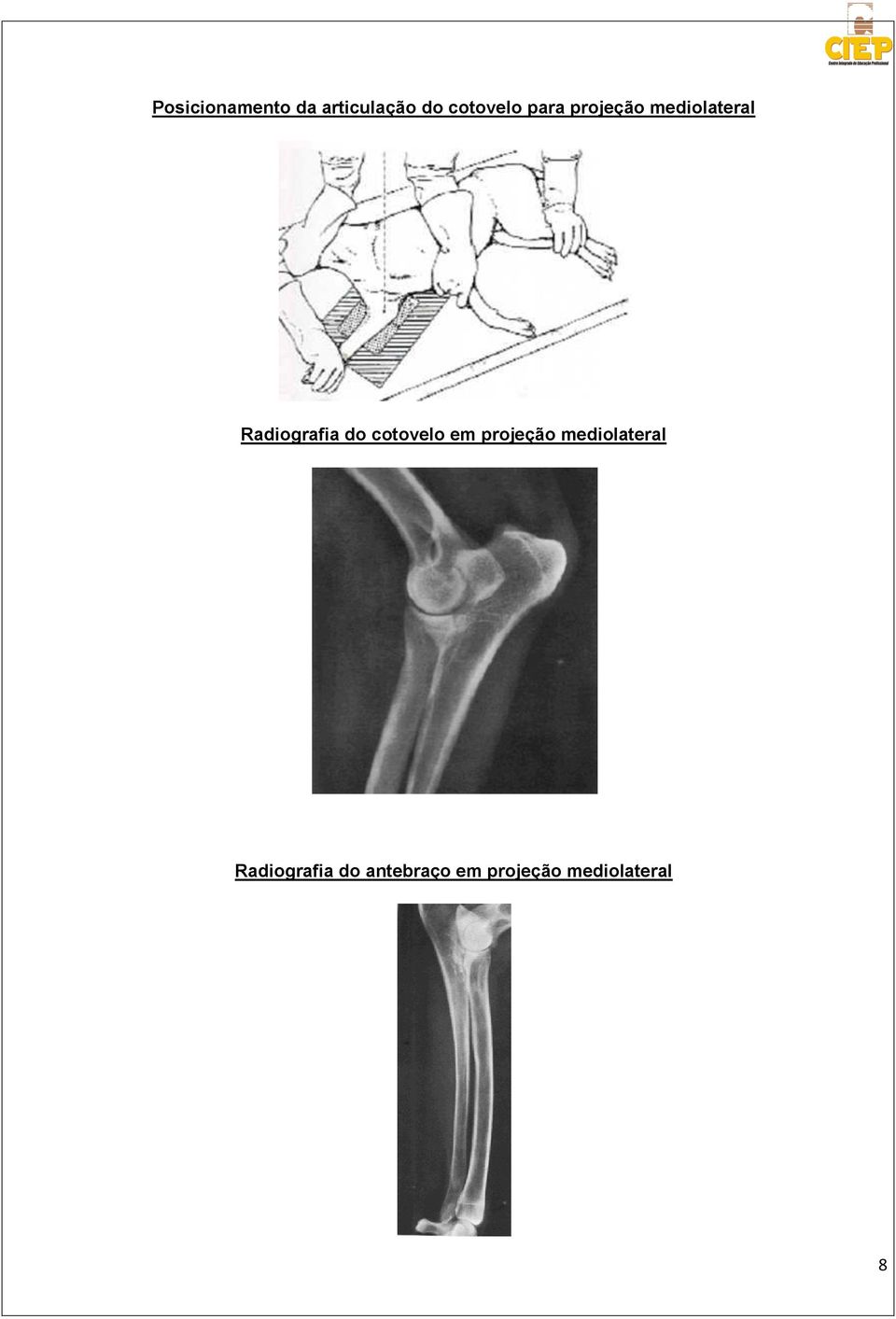 cotovelo em projeção mediolateral