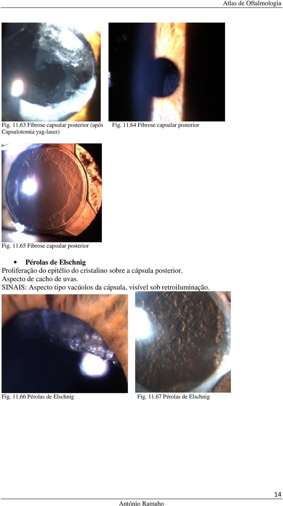 a cápsula posterior. Aspecto de cacho de uvas.