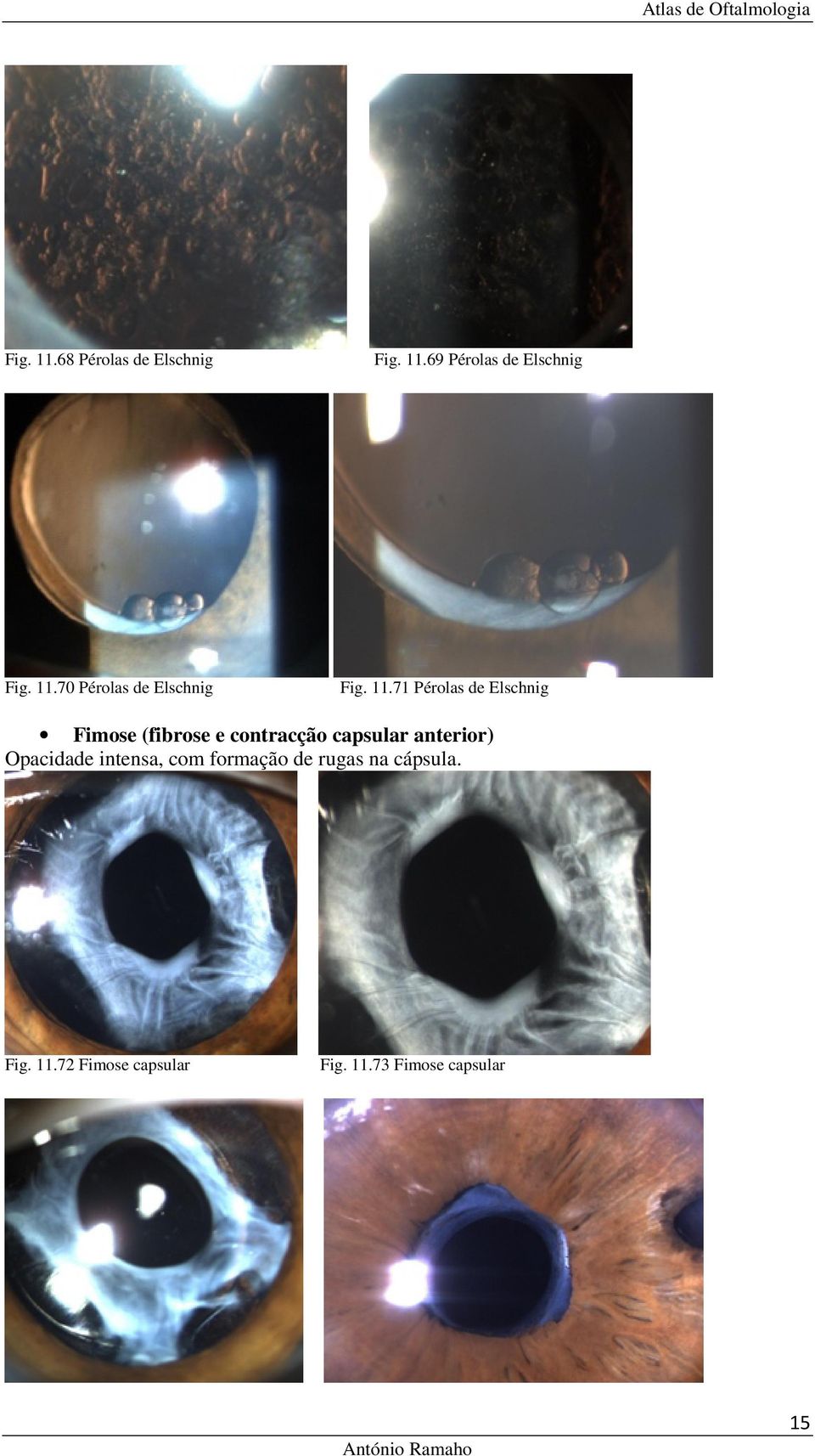 anterior) Opacidade intensa, com formação de rugas na cápsula. Fig. 11.