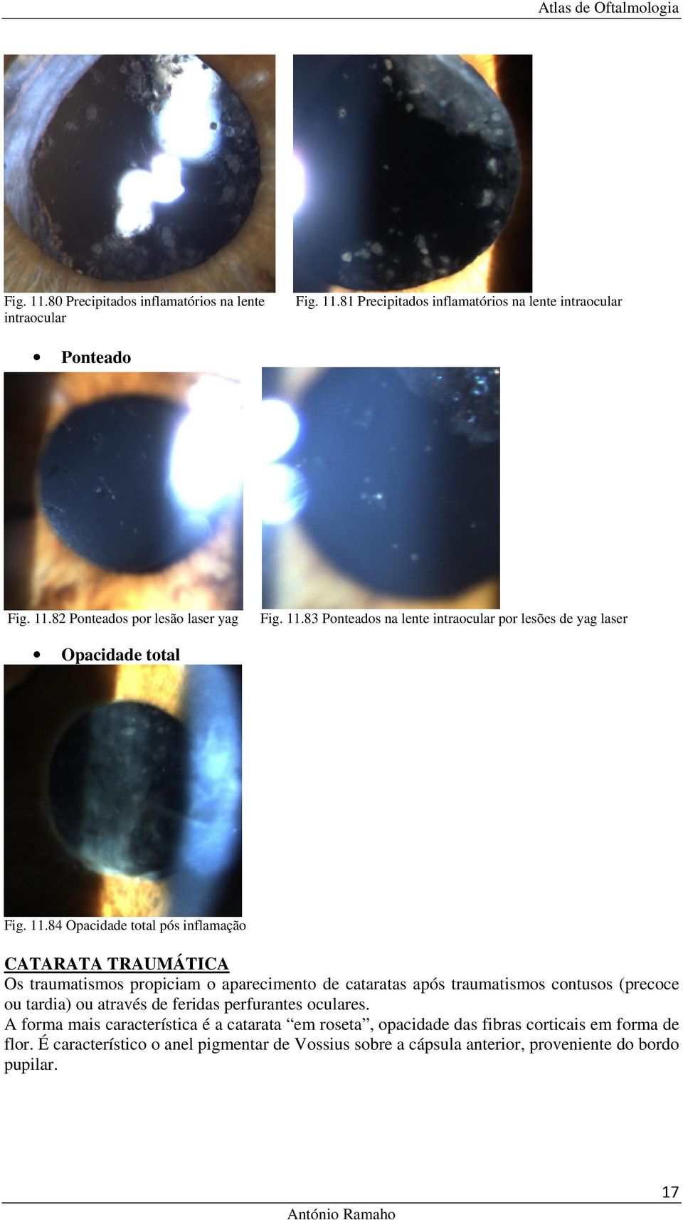 84 Opacidade total pós inflamação CATARATA TRAUMÁTICA Os traumatismos propiciam o aparecimento de cataratas após traumatismos contusos (precoce ou tardia) ou através