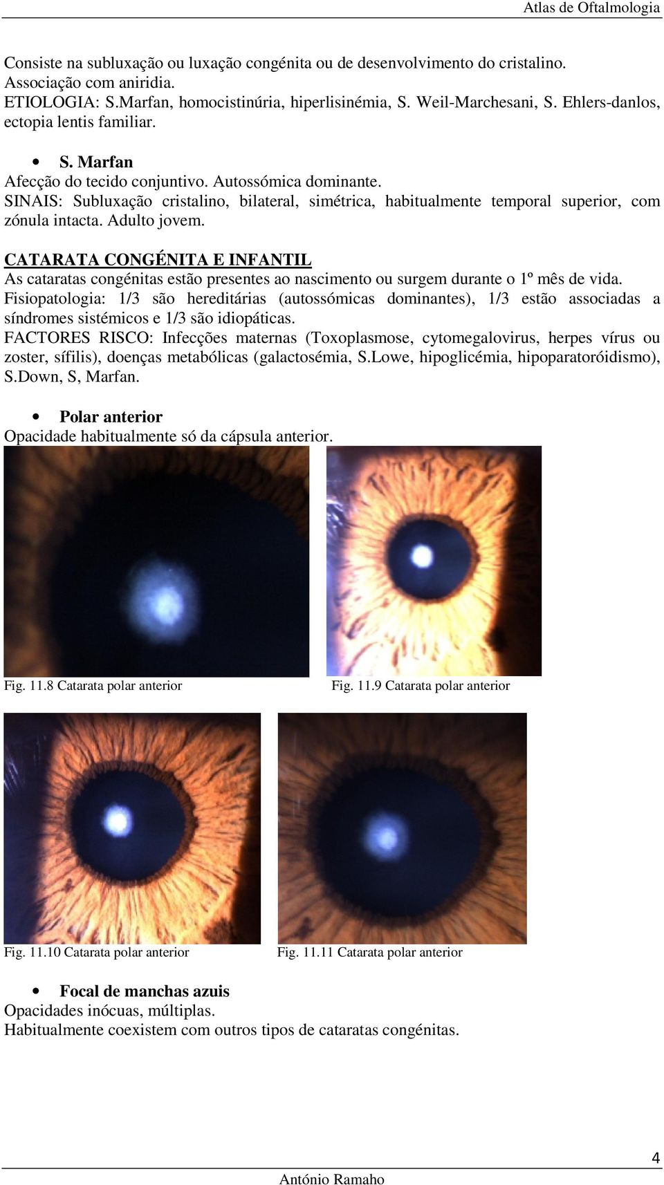 SINAIS: Subluxação cristalino, bilateral, simétrica, habitualmente temporal superior, com zónula intacta. Adulto jovem.