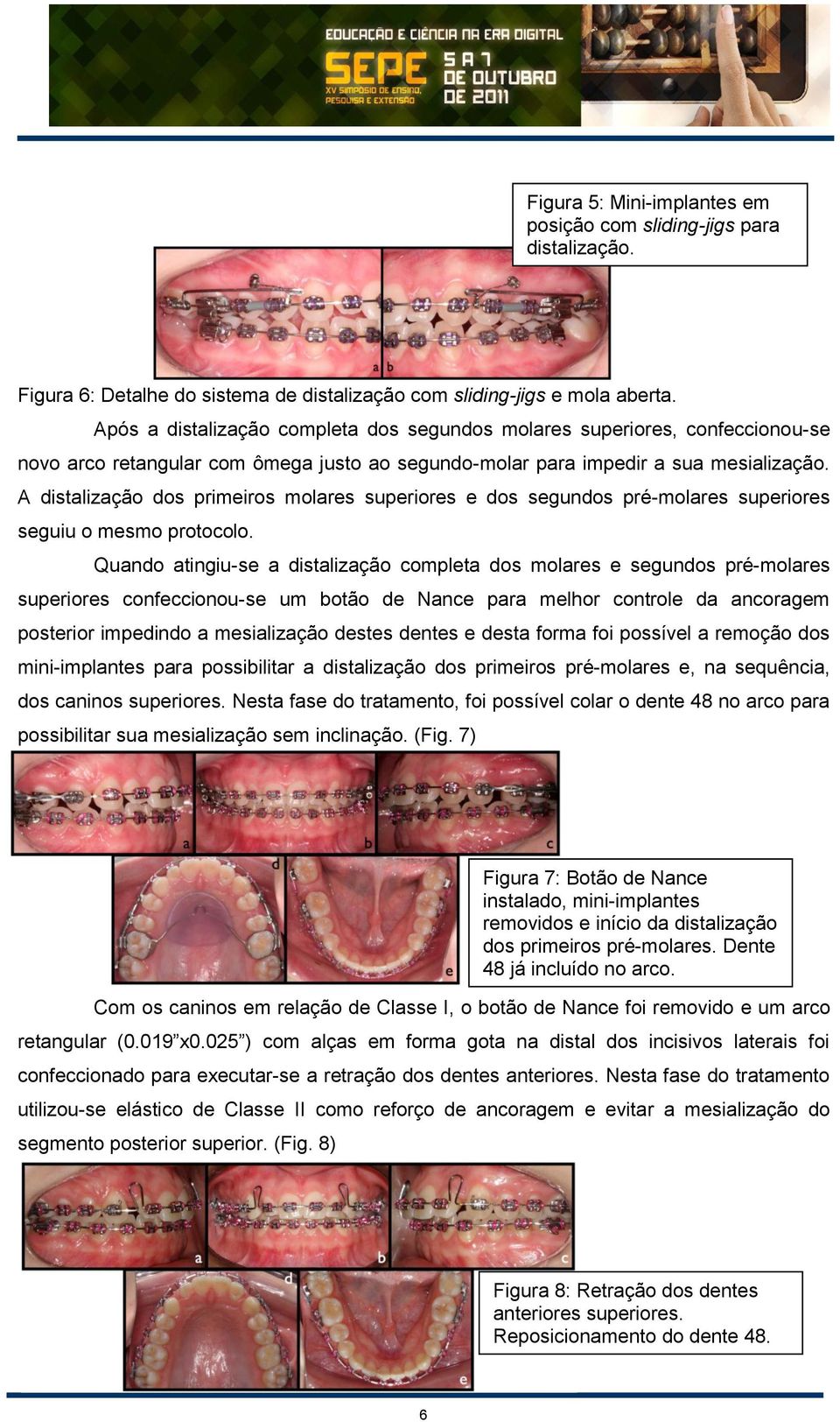 A distalização dos primeiros molares superiores e dos segundos pré-molares superiores seguiu o mesmo protocolo.