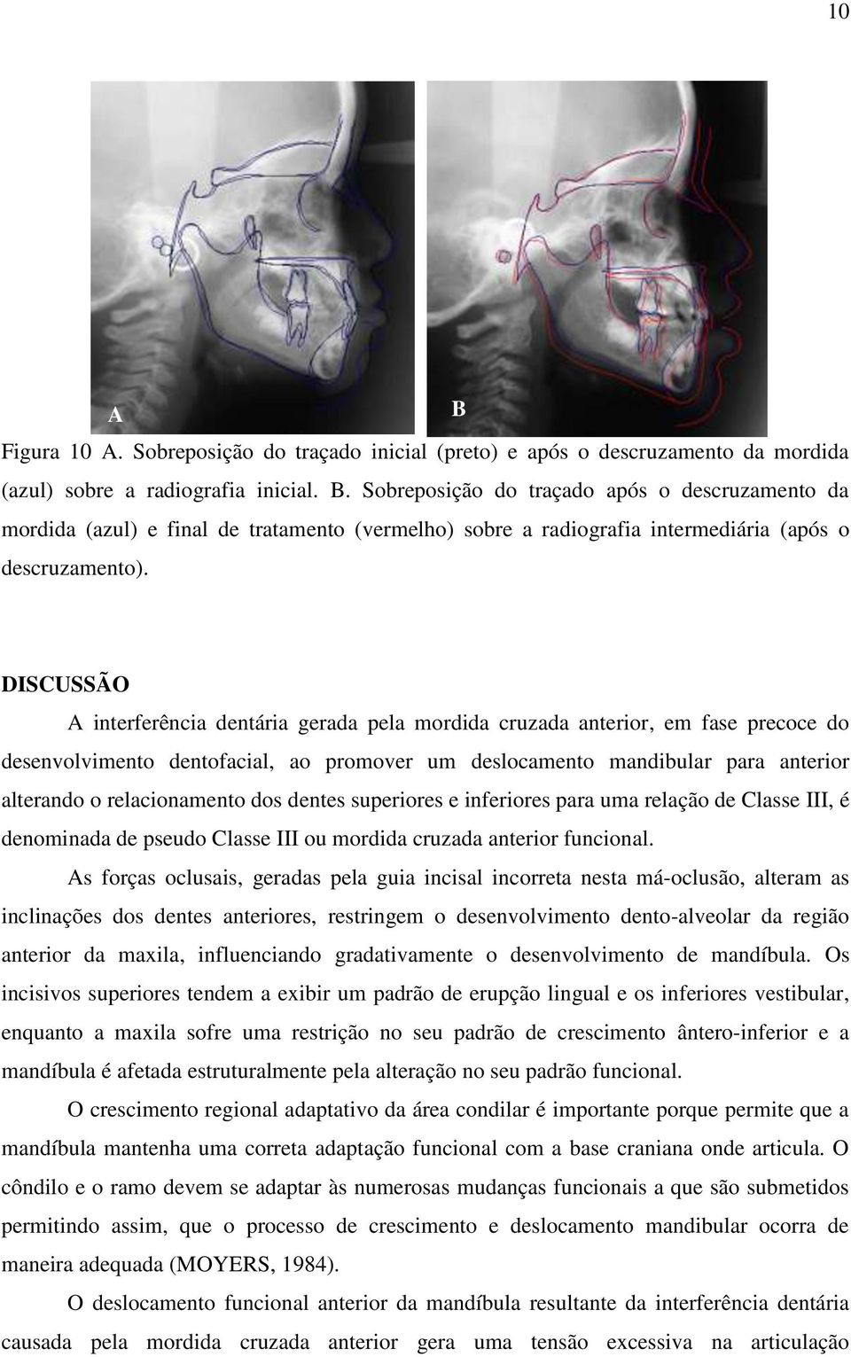 relacionamento dos dentes superiores e inferiores para uma relação de Classe III, é denominada de pseudo Classe III ou mordida cruzada anterior funcional.