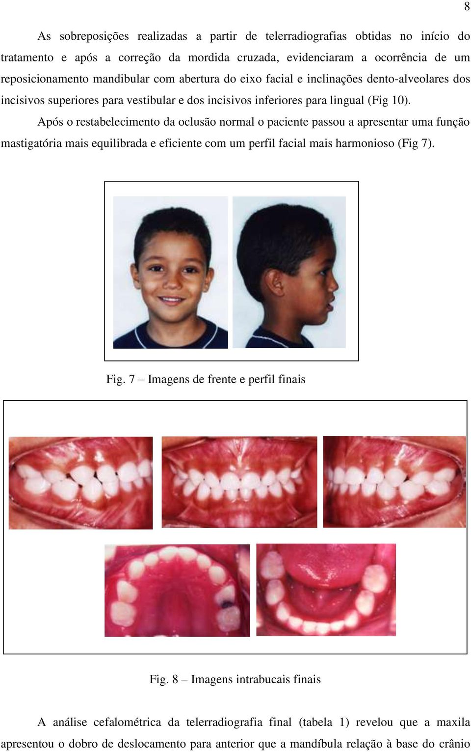 Após o restabelecimento da oclusão normal o paciente passou a apresentar uma função mastigatória mais equilibrada e eficiente com um perfil facial mais harmonioso (Fig 7). Fig.