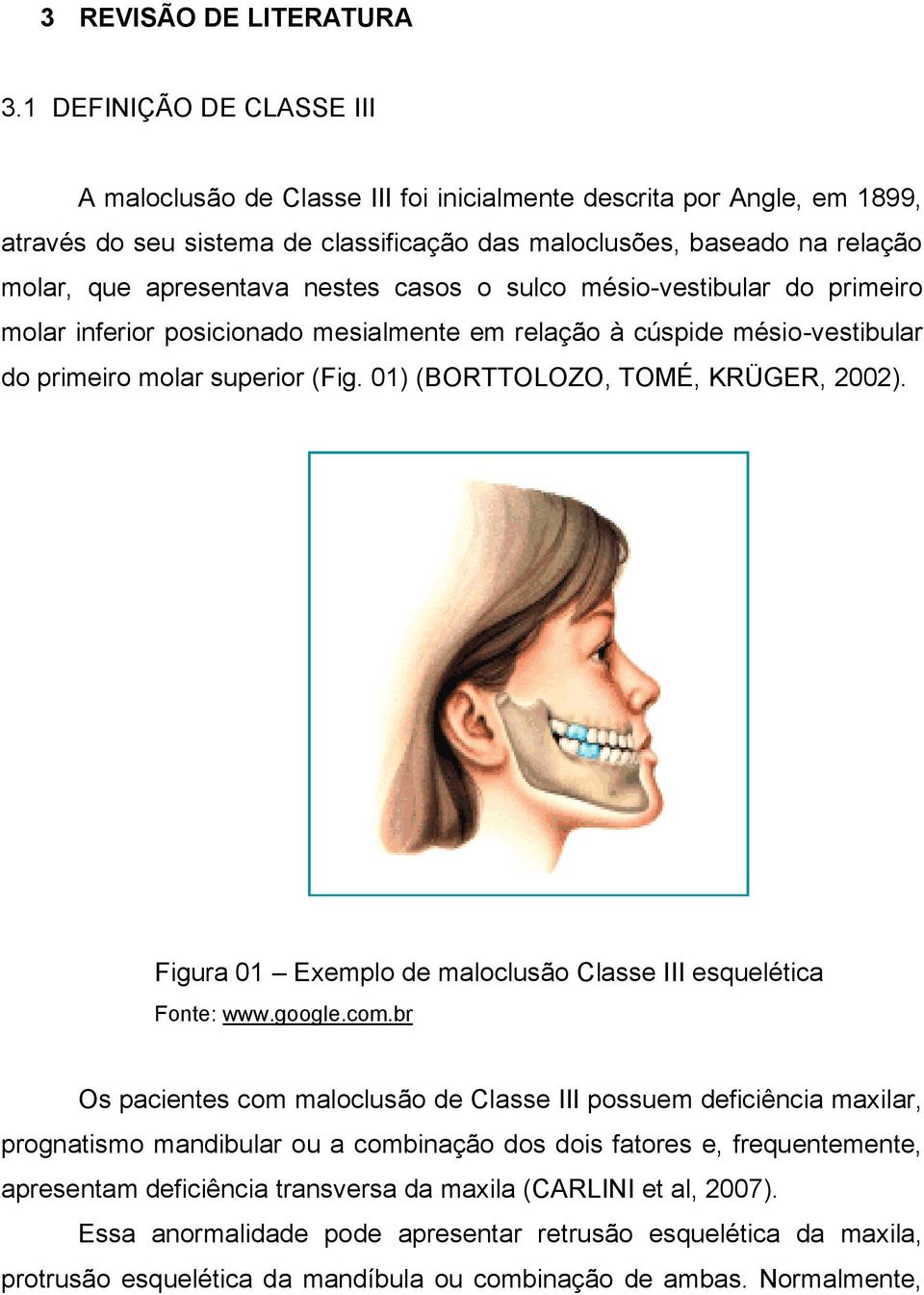 nestes casos o sulco mésio-vestibular do primeiro molar inferior posicionado mesialmente em relação à cúspide mésio-vestibular do primeiro molar superior (Fig. 01) (BORTTOLOZO, TOMÉ, KRÜGER, 2002).