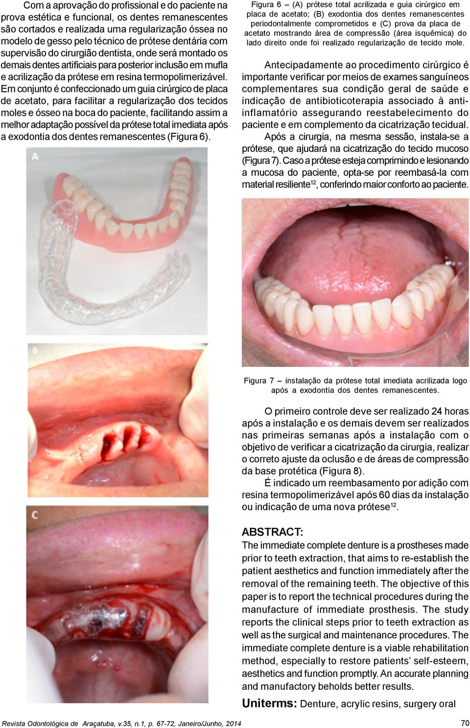 Em conjunto é confeccionado um guia cirúrgico de placa de acetato, para facilitar a regularização dos tecidos moles e ósseo na boca do paciente, facilitando assim a melhor adaptação possível da