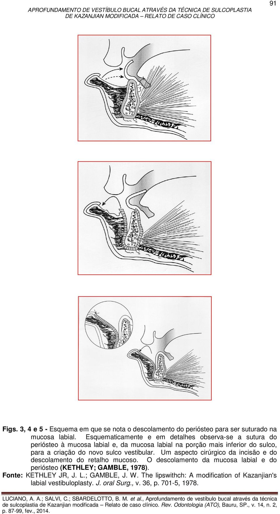 criação do novo sulco vestibular. Um aspecto cirúrgico da incisão e do descolamento do retalho mucoso.